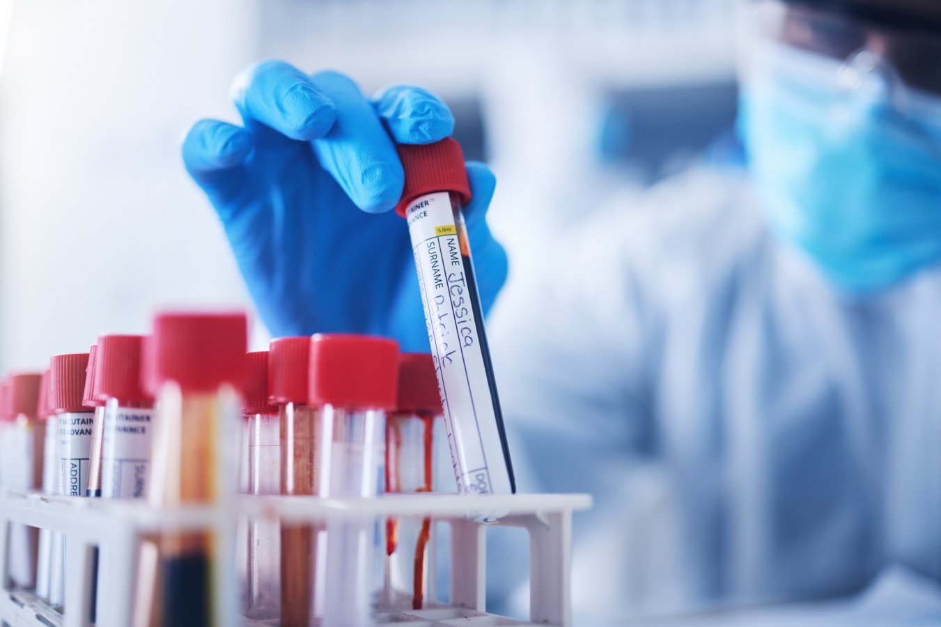 Timing of Blood Tests Might Lead to Misdiagnosed Anaemia